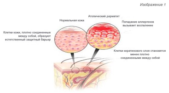Виды дерматитов и их симптомы