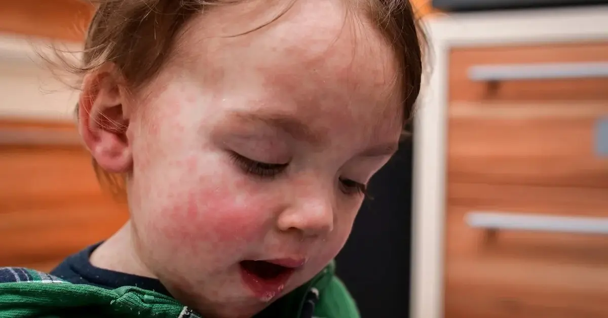 Как выглядит вирусная сыпь у ребенка?